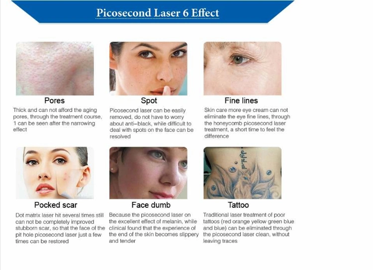 Picosecond Laser Q Switched ND YAG Laser Tattoo Removal Speckle Removal Pico Laser Tattoo Removal Eyebrow Line Beauty Device